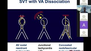 Badhwar 5 6 20 SVT with VA Dissociation