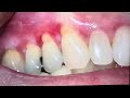 lichen planus oral sores part 122