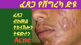 ፈጸጋ ብከመይ ንፍውሶ። ቀንዲ ጠንቅታት ፈጸጋ እንታይ እዮም። acne Definition and  treatment