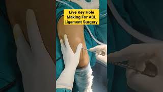 Live Key Hole Making For ACL Ligament Surgery | #aclsurgery #acl #acltear #mbbs #surgeon #doctor |