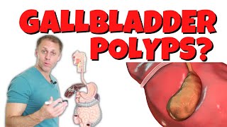 Why Do I Have Gallbladder Polyps