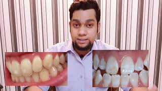 Dant k andar Stains? Dental Fluorosis