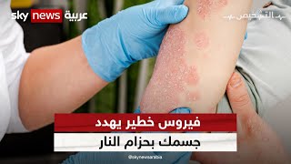 زنار النار والهربس والزونا أعراض غير متوقعة لآلام حادة | #برنامج_التشخيص