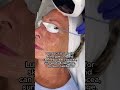 lumecca intense pulsed light treatment lumecca ipl near me lumecca results