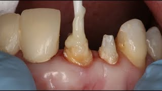 Dental Core Build Up and Post Cementation | Dental Online Training