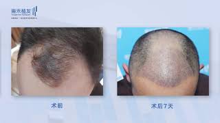 澳門lattlec微針加密，3405單位恢復全過程曝光Yonghe hair transplant