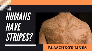 Blaschko's Lines - Do humans have stripes like a tiger or zebra?