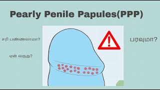 how to remove pearly penile papules | Tamil | Aankuri Mottu | bumps on penis