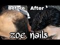 men hair patch 35,000 discount 10,000/-. | only on zoe nails | Rajouri garden metro station Delhi