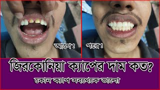 Zirconia Crown Price in Bangladesh || জিরকোনিয়া ক্যাপের দাম || কোন ক্যাপ ভালো ।। স্বাস্থ্য সেবা