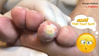 A soft corn and a callus removal|Κέντρο Ποδιού Podiatry|Αφαίρεση μαλακού κάλου|Ποδιατρική Ποδολογία