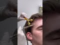 PRP treatment for hair thinning