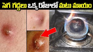 ఇలా చేస్తే ఒక్క రోజులో సెగ గడ్డలు మటుమాయం || How To Get Rid Of Boils | Sega gaddalu Home Remedies