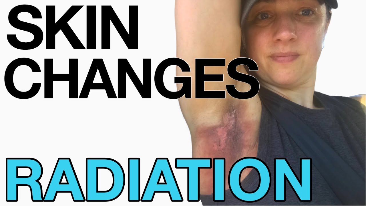 Breast Cancer RADIATION - What To Expect With Skin Changes - YouTube