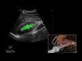 how to right kidney ultrasound 3d video