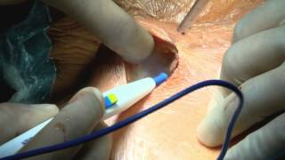 Carotid baroreceptor stimulation: Implantation procedure