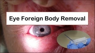 Eye Foreign Body Removal