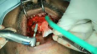 Part 1-All on 4 Dental implant surgery in Maxilla with Strauman Neodent  implants, chennai,India