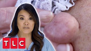 Dr Lee Removes A Bump She Named “Big Mama”! | Dr Pimple Popper Pop Up
