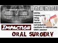 IMPACTION || ORAL SURGERY || DENTAL NOTES