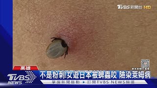 這真的不是粉刺!遊日本小心 女被蜱蟲咬險染萊姆病｜TVBS新聞 @TVBSNEWS01