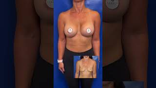 Review Breast Augmentation Results with Dr. Farber - 5 Months Post-Op