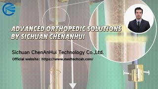 AO III External Fixator: Advanced Orthopedic Solutions by Sichuan Chenanhui