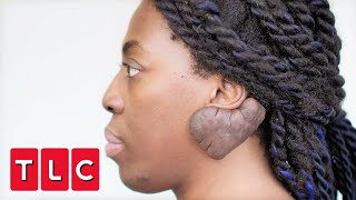 Dr Emma Helps Patient with A MASSIVE Keloid On The Back Of Her Ear | Bad Skin Clinic