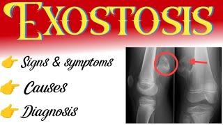 exostosis | causes | symptoms | diagnosis | treatment