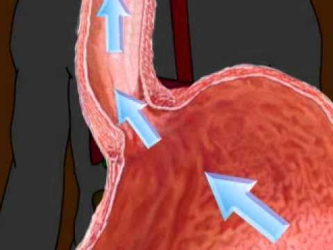 Cough caused by ACID REFLUX? Cough caused by ACID REFLUX?