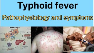 Typhoid fever Hindi Mae ||Typhoid fever: pathogenesis and symptoms || Typhoid fever kya h