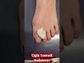 How to fix an ugly toenail