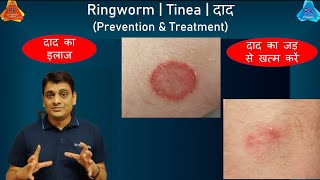 Fungal Ringworm - Complete Treatment | दाद का इलाज | Tinea | Dermatophytosis (By Dr. Puspendra)