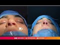 successful rhinoplasty cosmetico clinic dr. kamal ud din khan