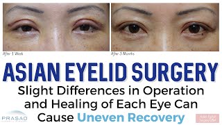 Asian Eyelid Surgery - Why Location of Incision is Not the Same as Final Crease Position