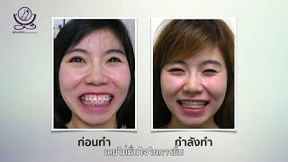 เคสยิ้มเห็นเหงือกยาว โหนกแก้มเยอะ ไม่ผ่าตัด (จัดฟัน จัดโครงสร้างใบหน้า)