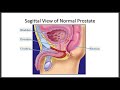 incontinence and voiding dysfunction in pd