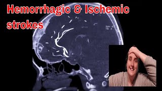 Cerebrovascular Accident(CVA) Stroke Hemorrhagic \u0026 Ischemic Causes Treatment and Prevention nursing