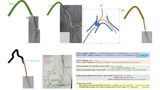 Lower extremity PAD interventions: General approach, techniques, and devices- Elias Hanna