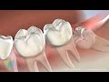 Wisdom Teeth Removal at Westwood Oral Surgery & Dental Implants