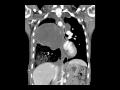 malignant peripheral nerve sheath tumor in nf 1