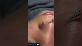 Extracting Large Blackheads Big Cystic Acne Blackheads&Whiteheads Removal Pimple Popping #143 #Short