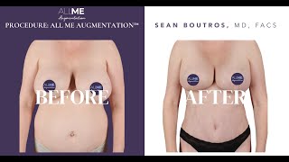 Case 3391 - Before / After. Procedure:  All Me Augmentation™ by Dr. Sean Boutros MD, FACS Houston