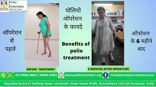 Benefits of polio treatment  after 6 months ( पोलियो ऑपरेशन  के फायदे 6 महीने बाद) #polio#deformity