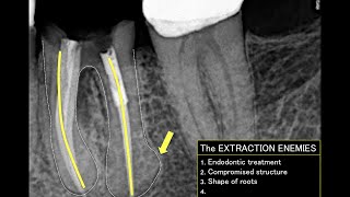 How to extract a lower molar (PART 1)