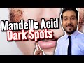 Mandelic Acid for Hyperpigmentation and Dark Spots | How to Use Mandelic Acid CORRECTLY