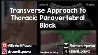 Transverse Approach to the Paravertebral Block