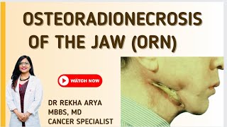 Osteoradionecrosis of Jaw (ORN )