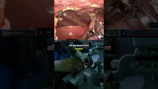 Robotic Thymectomy for Myasthenia Gravis #hospital #doctor #medicine #surgeon #learn #howto #learn