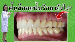 ฟันสึกคอฟันรักษายังไง?